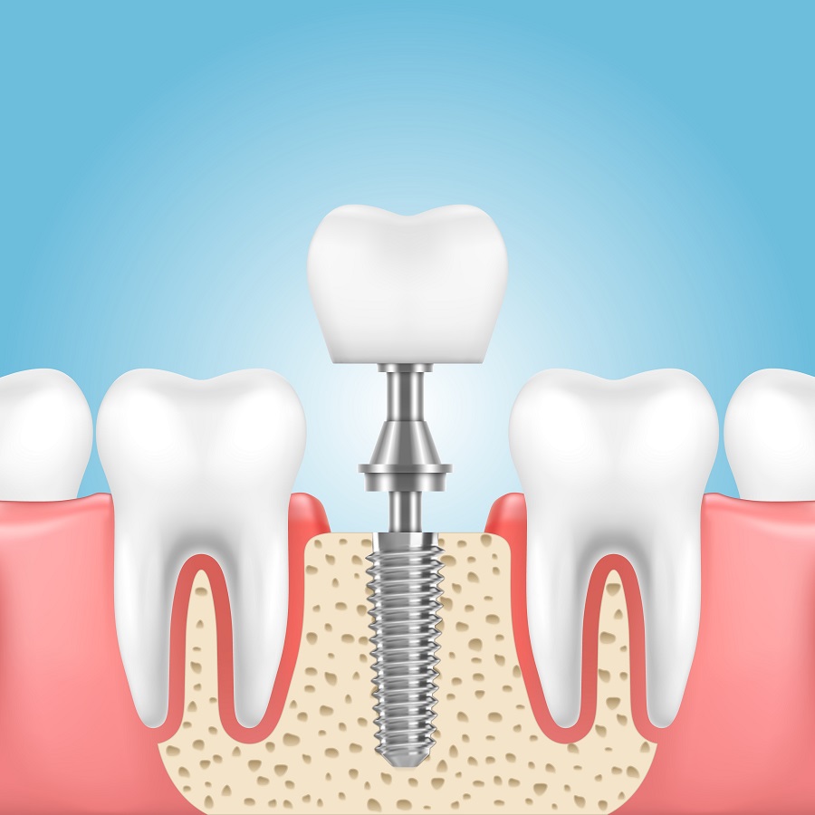 Dental Implants Dental Implants
