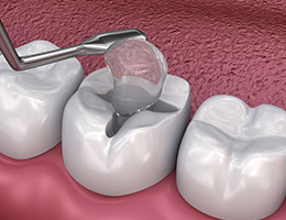 Cavity Repair Cavity Repair